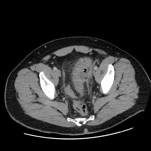 Acute diverticulitis with localized perforation (Radiopaedia 41296-44113 Axial C+ portal venous phase 79).jpg