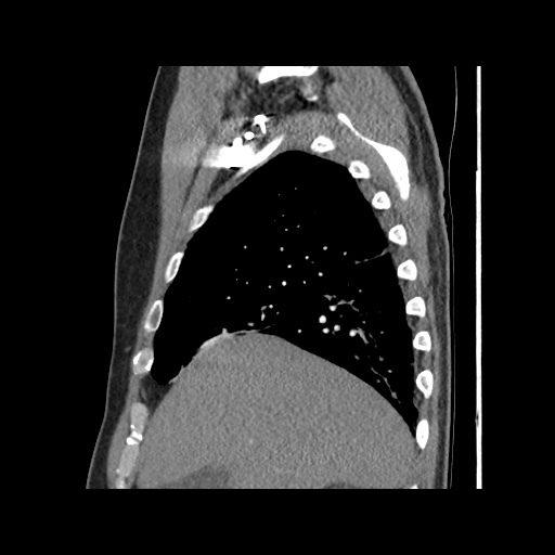 Acute epicardial fat necrosis (Radiopaedia 42327-45440 Sagittal C+ CTPA 21).jpg