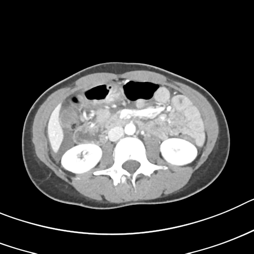Acute gangrenous appendicitis with perforation (Radiopaedia 40152-42662 Axial C+ portal venous phase 31).png