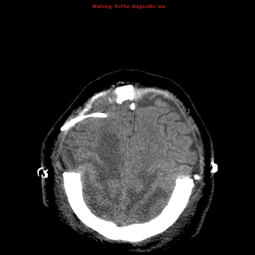 Acute hemorrhagic leukoencephalitis (Radiopaedia 14076-43697 Axial non-contrast 42).jpg