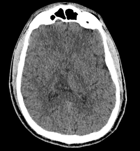 Acute ischemic stroke - posterior circulation territory (Radiopaedia 77670-89881 non-contrast 47).jpg