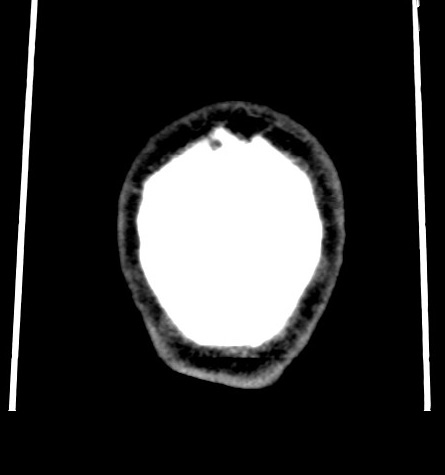 Acute left anterior cerebral artery territory infarction (Radiopaedia 51785-57578 Coronal non-contrast 59).jpg
