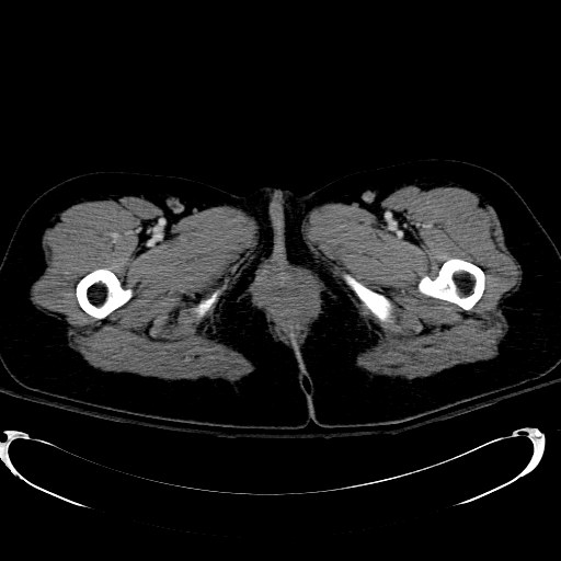 Acute myocardial infarction in CT (Radiopaedia 39947-42415 Axial C+ portal venous phase 152).jpg