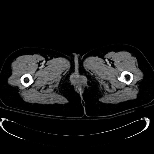 File:Acute myocardial infarction in CT (Radiopaedia 39947-42415 Axial C+ portal venous phase 154).jpg