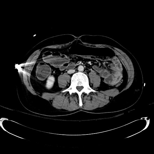 Acute myocardial infarction in CT (Radiopaedia 39947-42415 Axial C+ portal venous phase 73).jpg