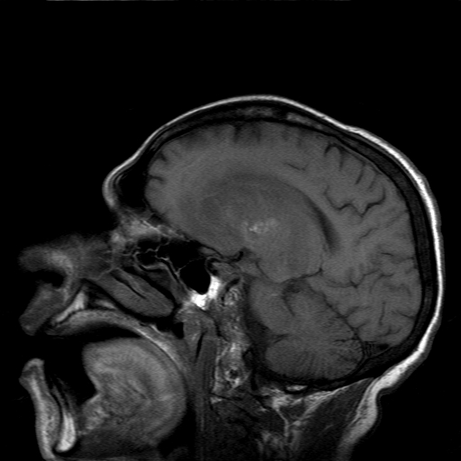 File:Acute necrotizing toxoplasma encephalitis (Radiopaedia 10683-11149 Sagittal T1 fat sat 8).jpg