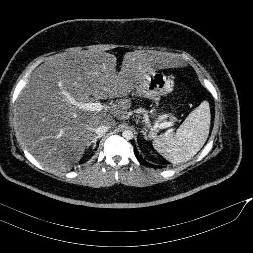 Acute on chronic pancreatitis (Radiopaedia 80902-94423 Axial C+ portal venous phase 41).jpg