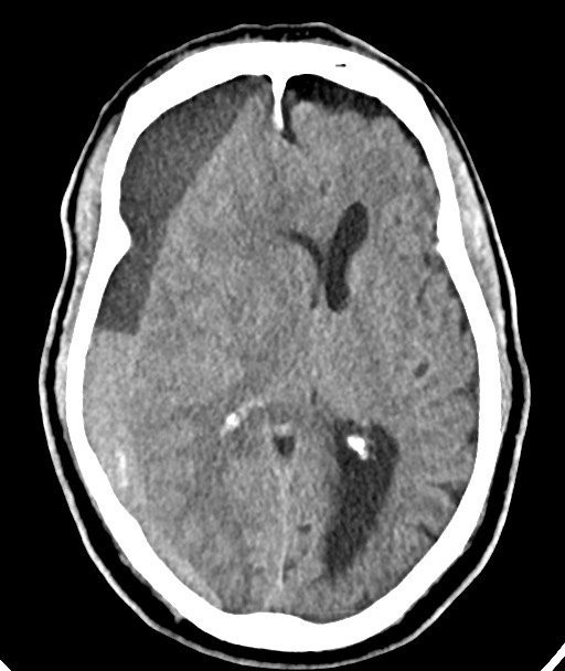 Acute on chronic subdural hematoma (Radiopaedia 78346-90966 Axial non-contrast 33).jpg