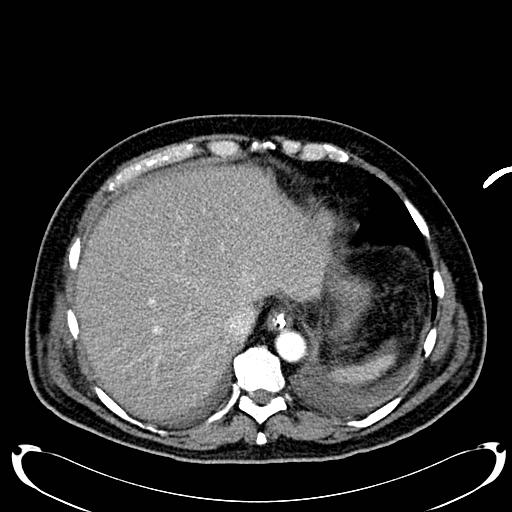 File:Acute pancreatic necrosis (Radiopaedia 13560-18500 Axial C+ portal venous phase 27).jpg