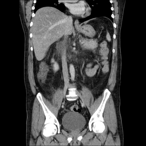 Acute pancreatitis (Radiopaedia 26663-26813 Coronal C+ portal venous phase 36).jpg