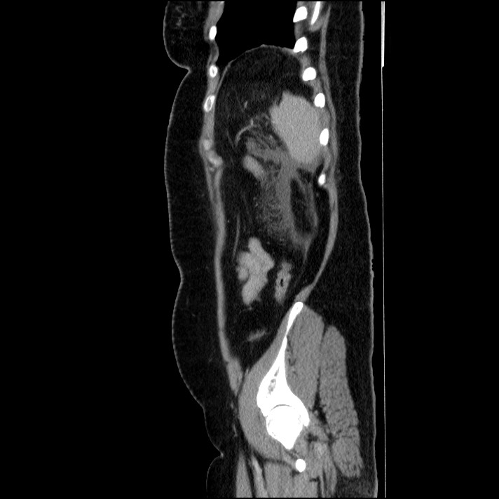 Acute pancreatitis (Radiopaedia 69236-79012 Sagittal C+ portal venous phase 26).jpg