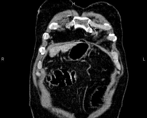 Acute pancreatitis (Radiopaedia 85146-100701 Coronal C+ portal venous phase 4).jpg