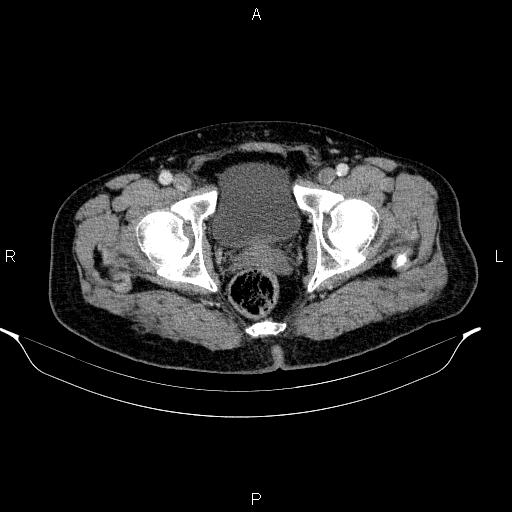 Acute pancreatitis (Radiopaedia 85390-101010 Axial C+ portal venous phase 105).jpg