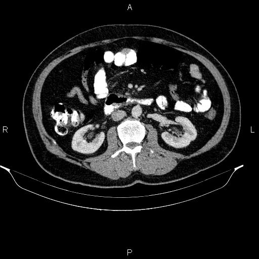 Acute pancreatitis (Radiopaedia 85390-101010 Axial C+ portal venous phase 50).jpg