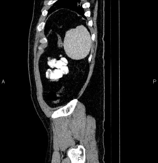 Acute pancreatitis (Radiopaedia 85390-101010 Sagittal C+ portal venous phase 94).jpg