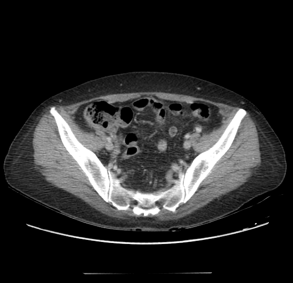 Acute pancreatitis - Balthazar E - post ERCP (Radiopaedia 27562-27772 Axial C+ portal venous phase 62).png