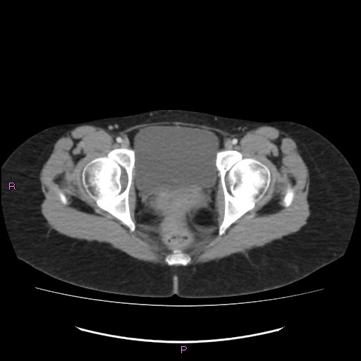 Acute pancreatitis secondary to stone at minor papilla and pancreatic divisum (Radiopaedia 76570-88333 Axial C+ portal venous phase 77).jpg