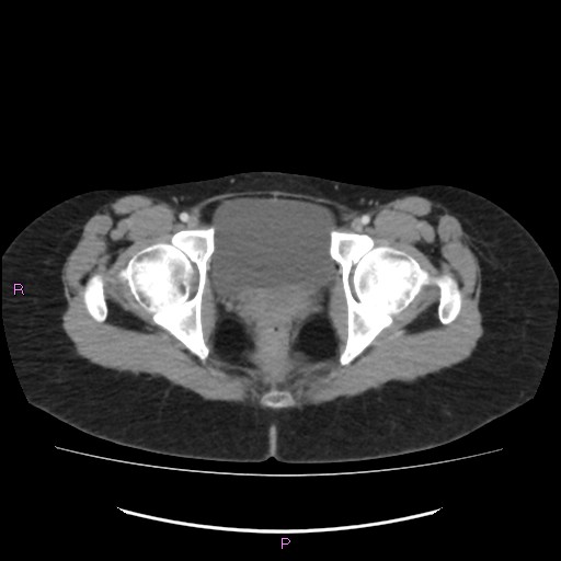 File:Acute pancreatitis secondary to stone at minor papilla and pancreatic divisum (Radiopaedia 76570-88333 Axial C+ portal venous phase 78).jpg