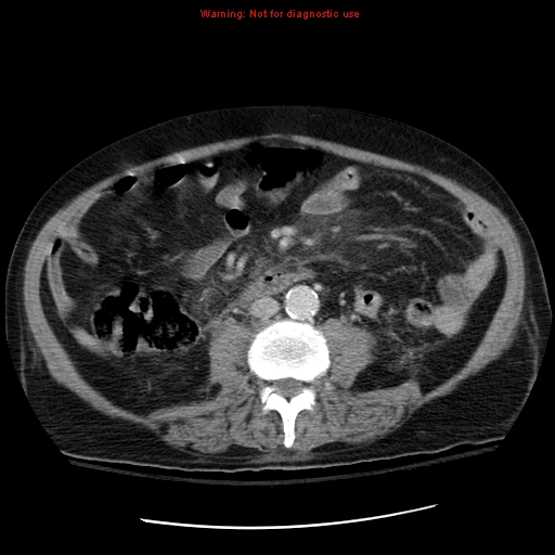 File:Acute pancreatitis with incidental pancreatic lipoma (Radiopaedia 10190-10730 Axial C+ portal venous phase 42).jpg