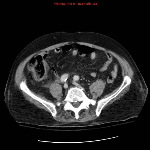 File:Acute pancreatitis with incidental pancreatic lipoma (Radiopaedia 10190-10730 Axial C+ portal venous phase 53).jpg