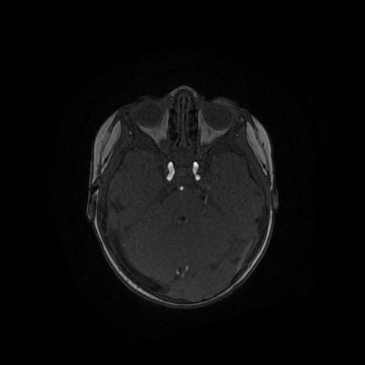 Acute phase of hemiconvulsion-hemiplegia epilepsy syndrome (Radiopaedia 29309-29745 Axial TOF angiography 101).jpg