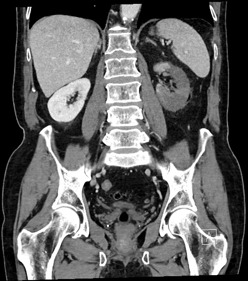 File:Acute renal infarction (Radiopaedia 59375-66736 Coronal C+ portal venous phase 41).jpg