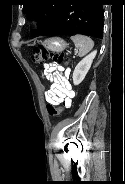 Acute renal infarction - rim capsular enhancement (Radiopaedia 59833-67270 Sagittal C+ portal venous phase 22).jpg