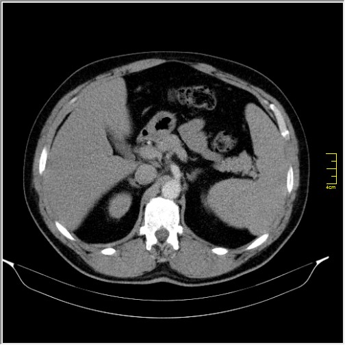 Acute right sided diverticulitis (Radiopaedia 65249-74268 Axial C+ portal venous phase 21).JPG