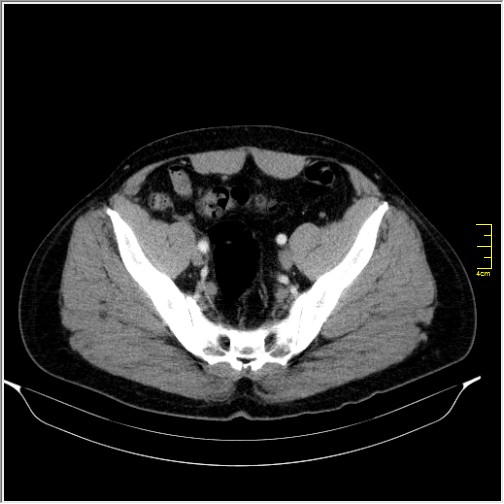 Acute right sided diverticulitis (Radiopaedia 65249-74268 Axial C+ portal venous phase 65).JPG