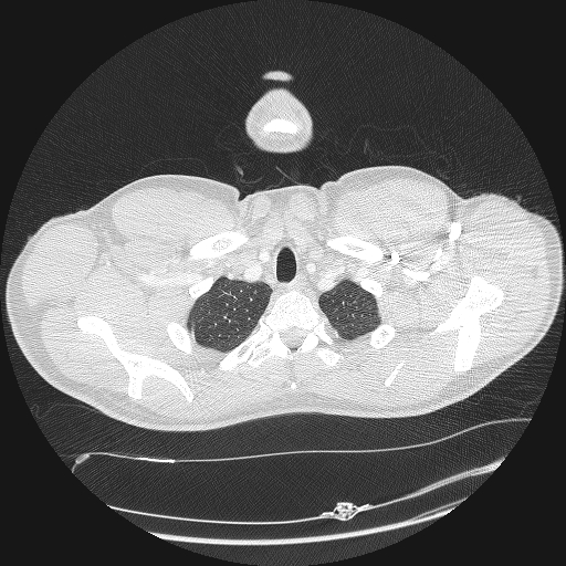File:Acute segmental pulmonary emboli and pulmonary infarction (Radiopaedia 62264-70444 Axial lung window 9).jpg