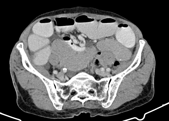 Acute small bowel (ileal) volvulus (Radiopaedia 71740-82139 Axial C+ portal venous phase 148).jpg