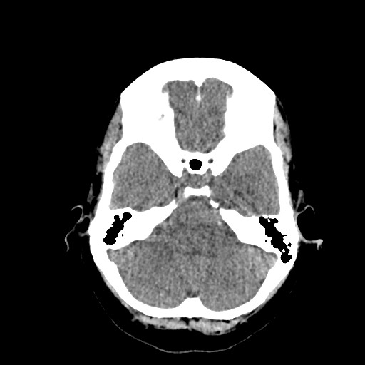 Acute subarachnoid hemorrhage and accessory anterior cerebral artery (Radiopaedia 69231-79008 Axial non-contrast 14).jpg