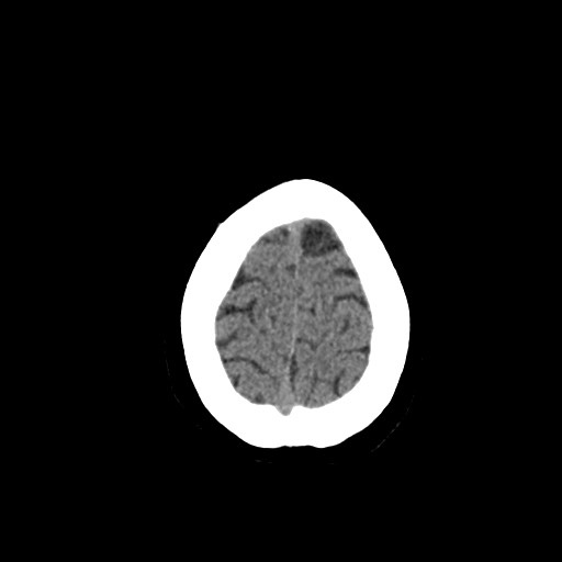 Acute subarachnoid hemorrhage and accessory anterior cerebral artery (Radiopaedia 69231-79008 Axial non-contrast 49).jpg