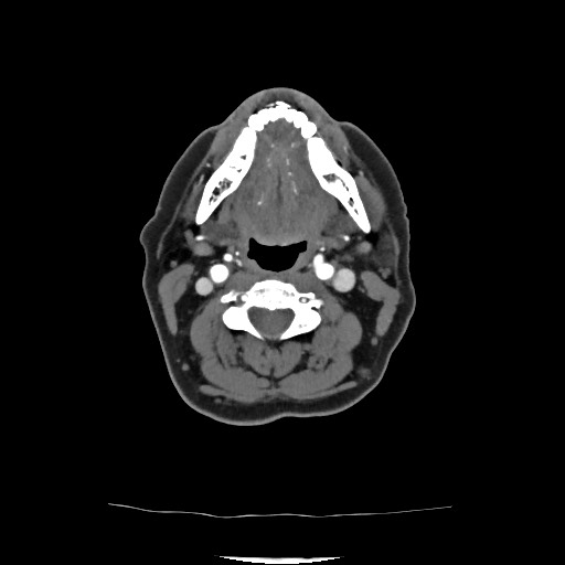 Acute subarachnoid hemorrhage and accessory anterior cerebral artery (Radiopaedia 69231-79009 Axial C+ arterial phase 57).jpg