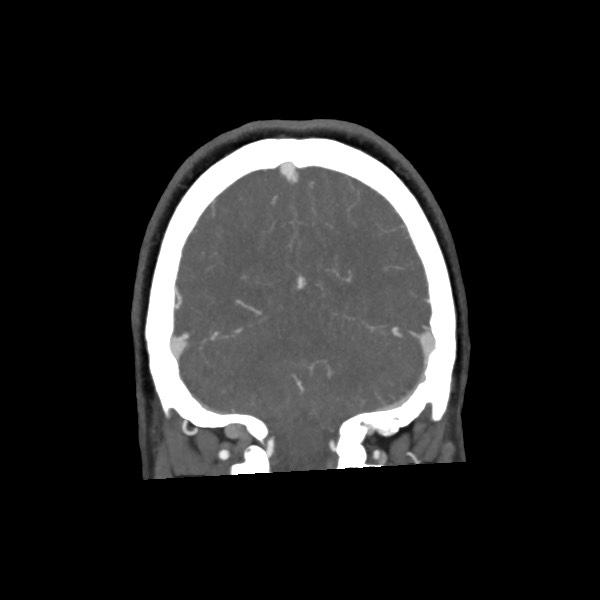 File:Acute subarachnoid hemorrhage and accessory anterior cerebral artery (Radiopaedia 69231-79009 Coronal C+ arterial phase 64).jpg