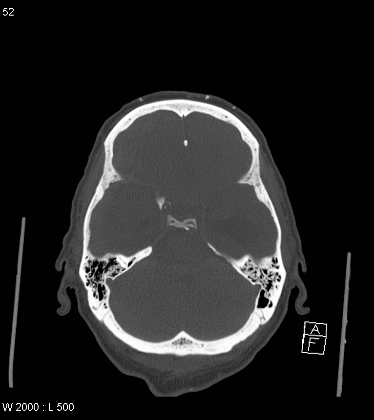 Acute subdural hematoma with myelofibrosis (Radiopaedia 52582-58494 Axial bone window 26).jpg