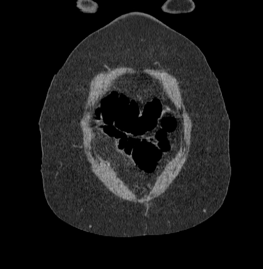File:Acute superior mesenteric artery occlusion (Radiopaedia 51288-56960 Coronal C+ portal venous phase 7).jpg