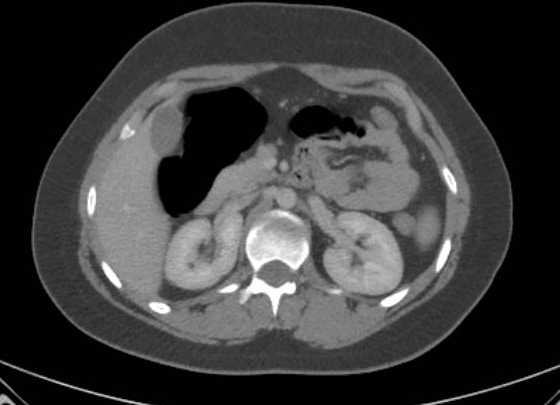 File:Acute unilateral nonhemorrhagic adrenal infarction (Radiopaedia 67560-76957 Axial renal parenchymal phase 59).jpg