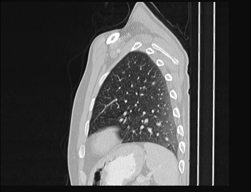 Addison disease (Radiopaedia 49318-54412 Sagittal lung window 13).jpg