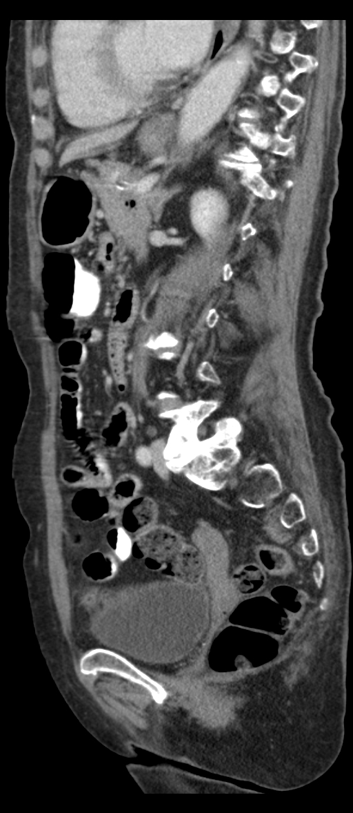 Adenocarcinoma of cecum (Radiopaedia 59222-66549 Sagittal C+ portal venous phase 35).jpg