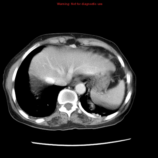 File:Adenocarcinoma of the colon (Radiopaedia 8191-9039 Axial liver window 12).jpg
