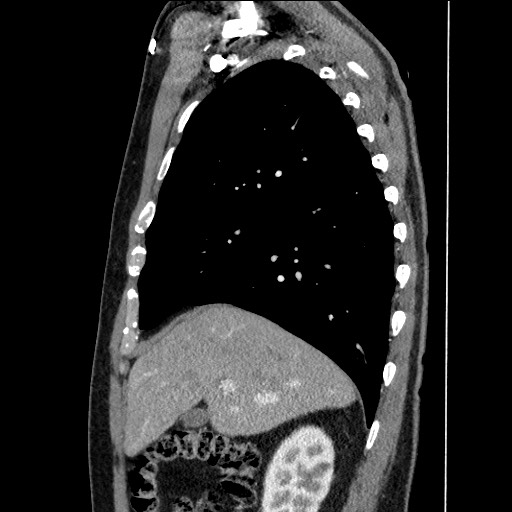Adenocarcinoma of the lung (Radiopaedia 59871-67325 Sagittal C+ arterial phase 26).jpg