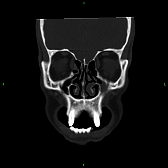 File:Adenoid cystic carcinoma of hard palate (Radiopaedia 26137-26273 Coronal bone window 6).jpg