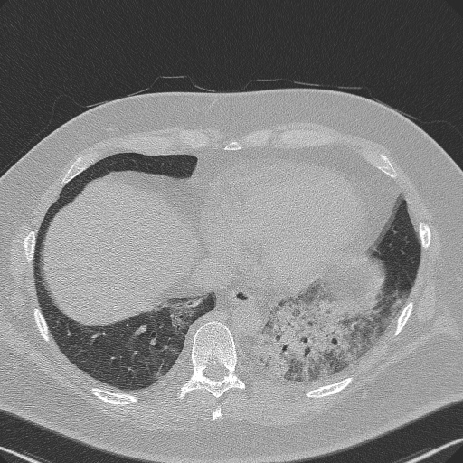 Adenoid cystic carcinoma of the trachea (Radiopaedia 49042-54137 Axial lung window 265).jpg