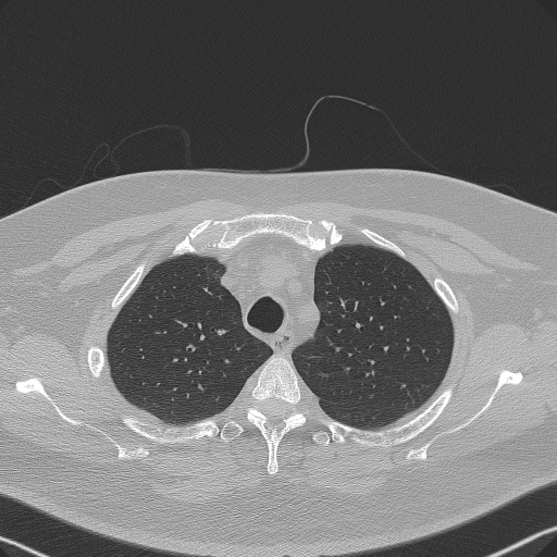 File:Adenoid cystic carcinoma of the trachea (Radiopaedia 49042-54137 Axial lung window 75).jpg