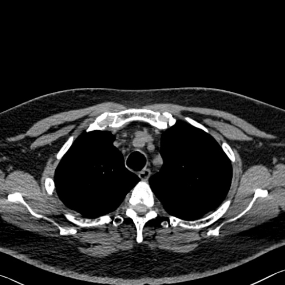 Adenoid cystic carcinoma of the trachea (Radiopaedia 49042-54137 Axial non-contrast 74).jpg