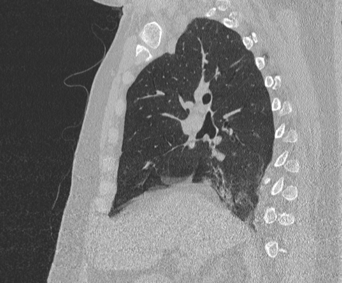 File:Adenoid cystic carcinoma of the trachea (Radiopaedia 49042-54137 Sagittal lung window 190).jpg