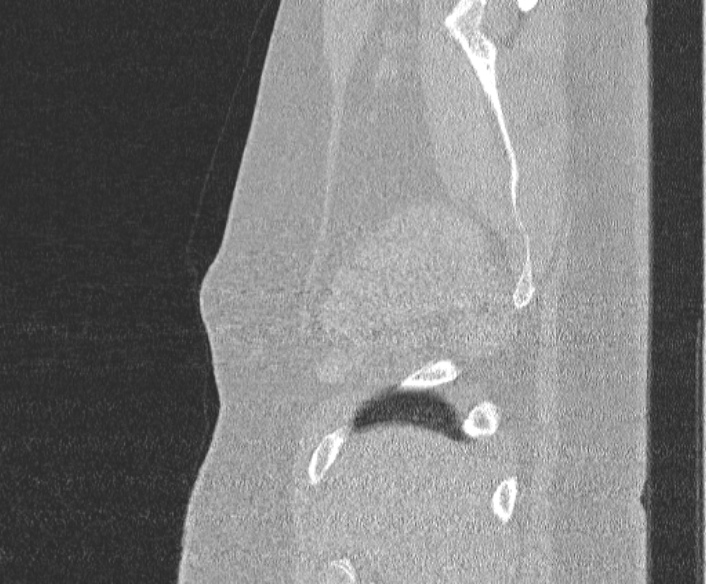 Adenoid cystic carcinoma of the trachea (Radiopaedia 49042-54137 Sagittal lung window 30).jpg