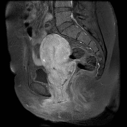 File:Adenomyosis-scar endometriosis (Radiopaedia 65863-75022 Sagittal T1 C+ fat sat 13).jpg