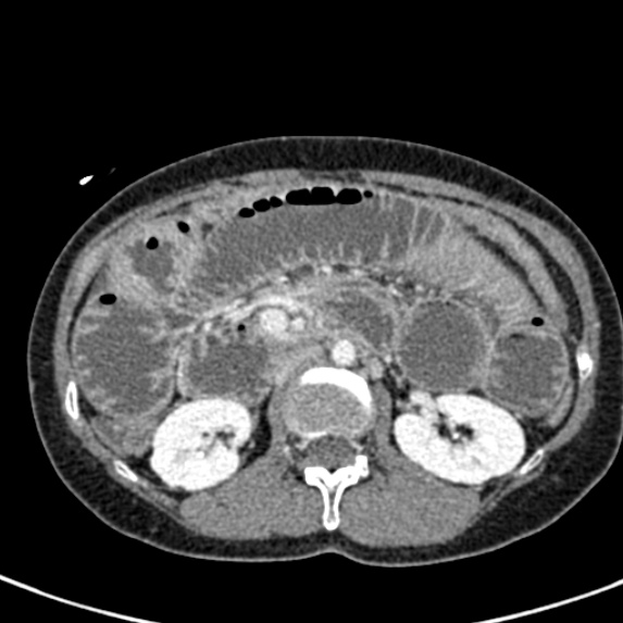File:Adhesional small bowel obstruction (Radiopaedia 48397-53305 Axial C+ portal venous phase 30).jpg